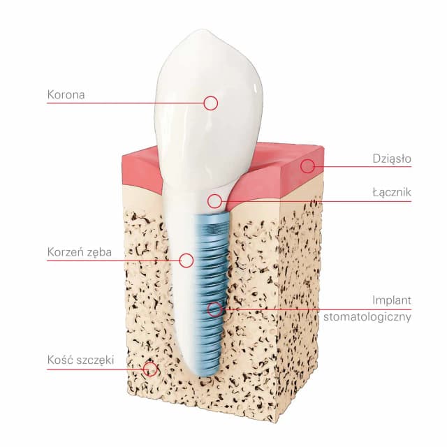 Co to jest implant zęba? Wszystko, co musisz wiedzieć o korzyściach i procesie implantacji Co to jest implant zęba? Wszystko, co musisz wiedzieć o korzyściach i procesie implantacji