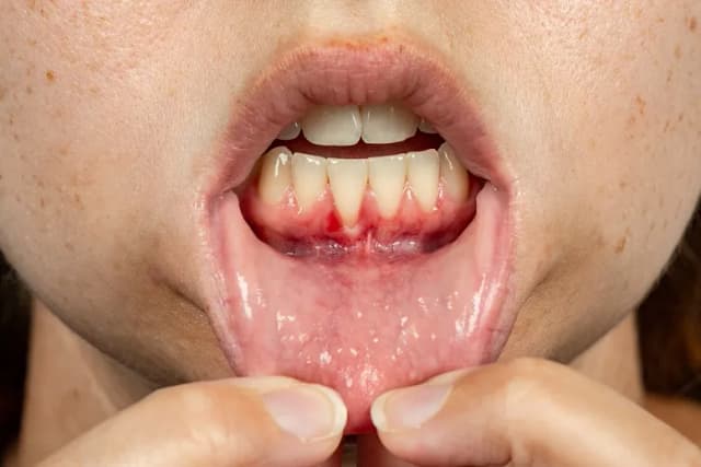 Dlaczego dziąsła się cofają? Przyczyny, objawy i skuteczne sposoby leczenia Dlaczego dziąsła się cofają? Przyczyny, objawy i skuteczne sposoby leczenia