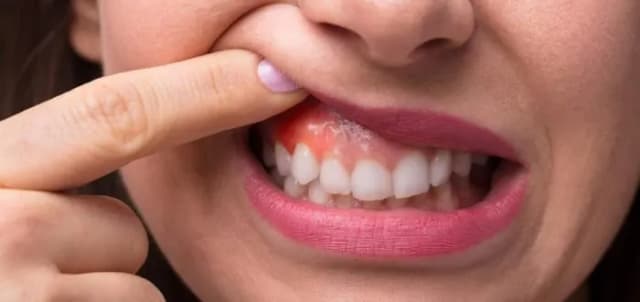 Skuteczne sposoby na opuchnięte dziąsła – domowe metody i leki bez recepty Skuteczne sposoby na opuchnięte dziąsła – domowe metody i leki bez recepty