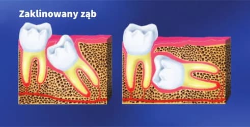 Objawy zęba mądrości: jak rozpoznać ból, stany zapalne i kiedy iść do dentysty Objawy zęba mądrości: jak rozpoznać ból, stany zapalne i kiedy iść do dentysty