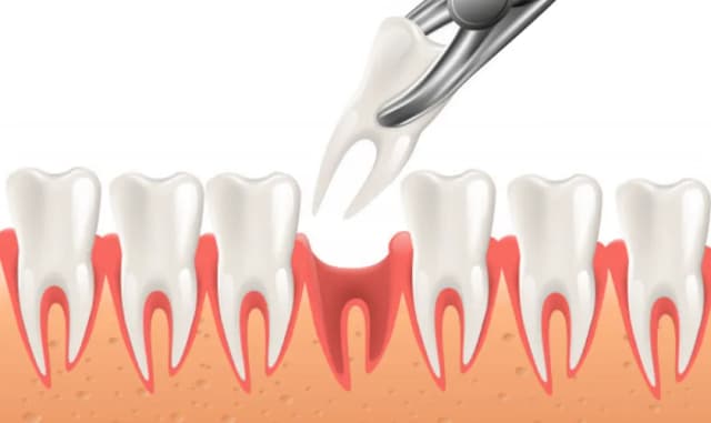 Co dentysta wkłada do zęba po usunięciu? Wyjaśniamy proces i zalecenia po zabiegu Co dentysta wkłada do zęba po usunięciu? Wyjaśniamy proces i zalecenia po zabiegu