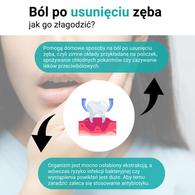Jak długo boli po usunięciu zęba i jak złagodzić nieprzyjemne dolegliwości Jak długo boli po usunięciu zęba i jak złagodzić nieprzyjemne dolegliwości