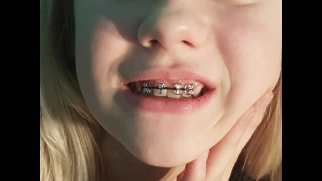 Czy można bezpiecznie zrobić sztuczny aparat na zęby w domu? Ryzyka i alternatywy Czy można bezpiecznie zrobić sztuczny aparat na zęby w domu? Ryzyka i alternatywy